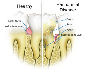 Healthy gums vs Periodontal Disease